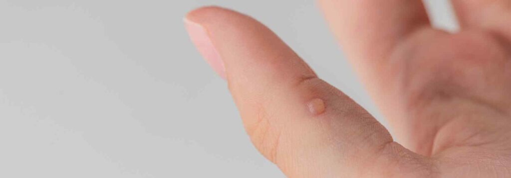Close up image of a wart on thumb