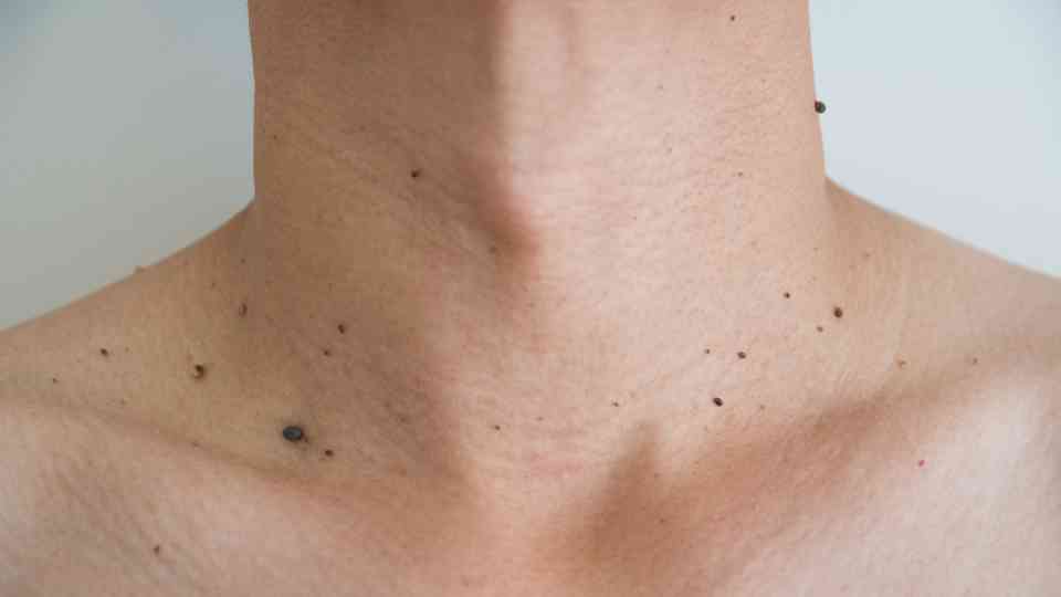 Cryotherapy can remove actinic keratosis and defend against skin cancer.