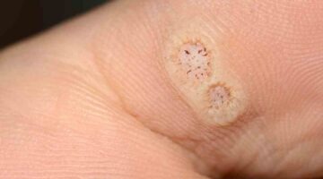 Wart freeze treatment near me.