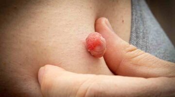 How can you remove a skin tag at home?