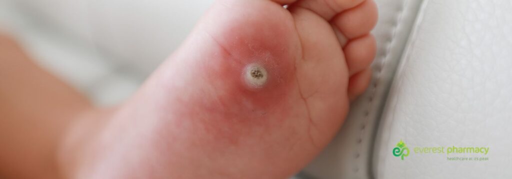 Verruca on the underneath of a child's foot