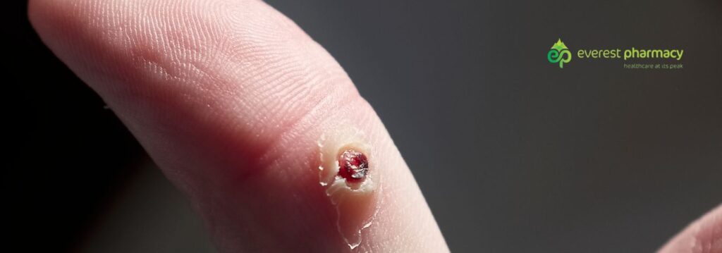 Wart on finger