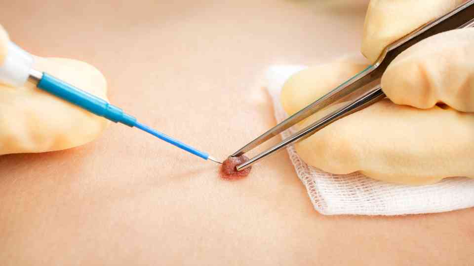 How to remove skin tags without scarring