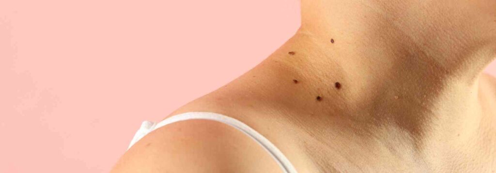 How can we remove skin tags quickly?