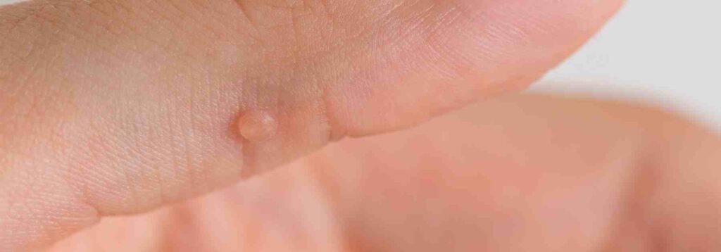 What causes tag warts in adults?