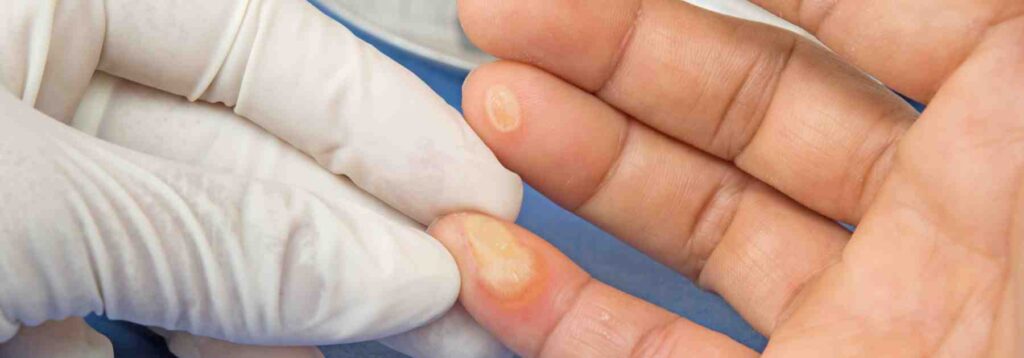 What causes tag warts to spread?