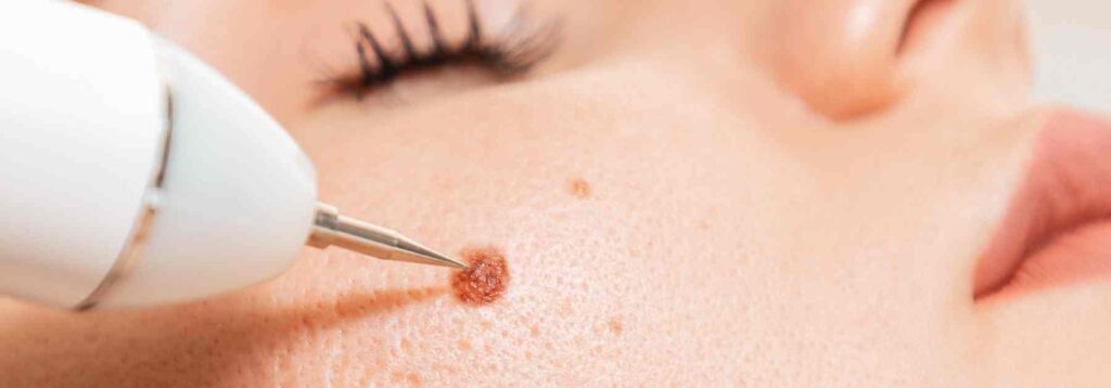 Cryotherapy wand to remove facial blemish