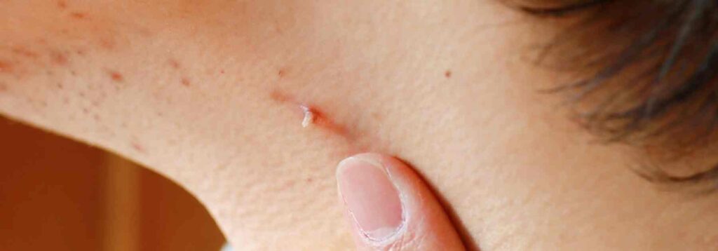 Skin tag on neck close up image