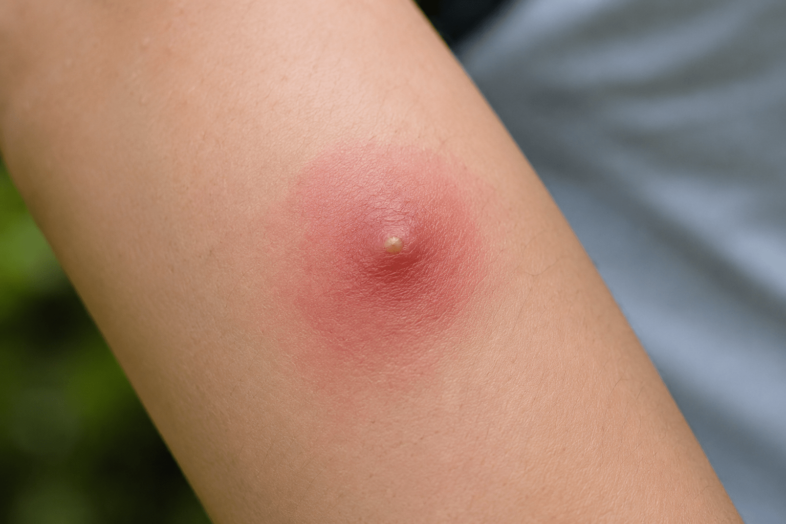 Infected insect bite pharmacy service