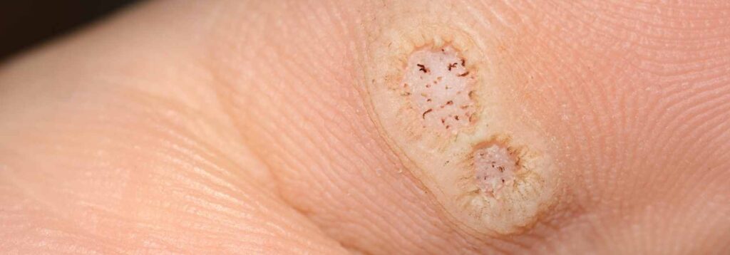 Close up image of a wart or verruca