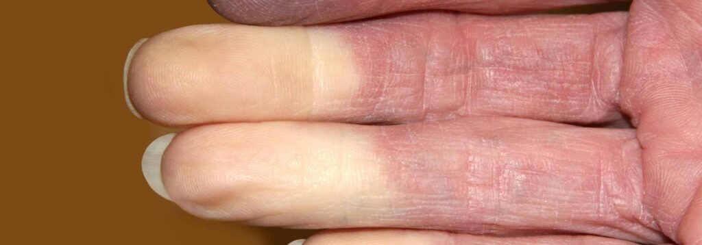 Raynaud's phenomenon 